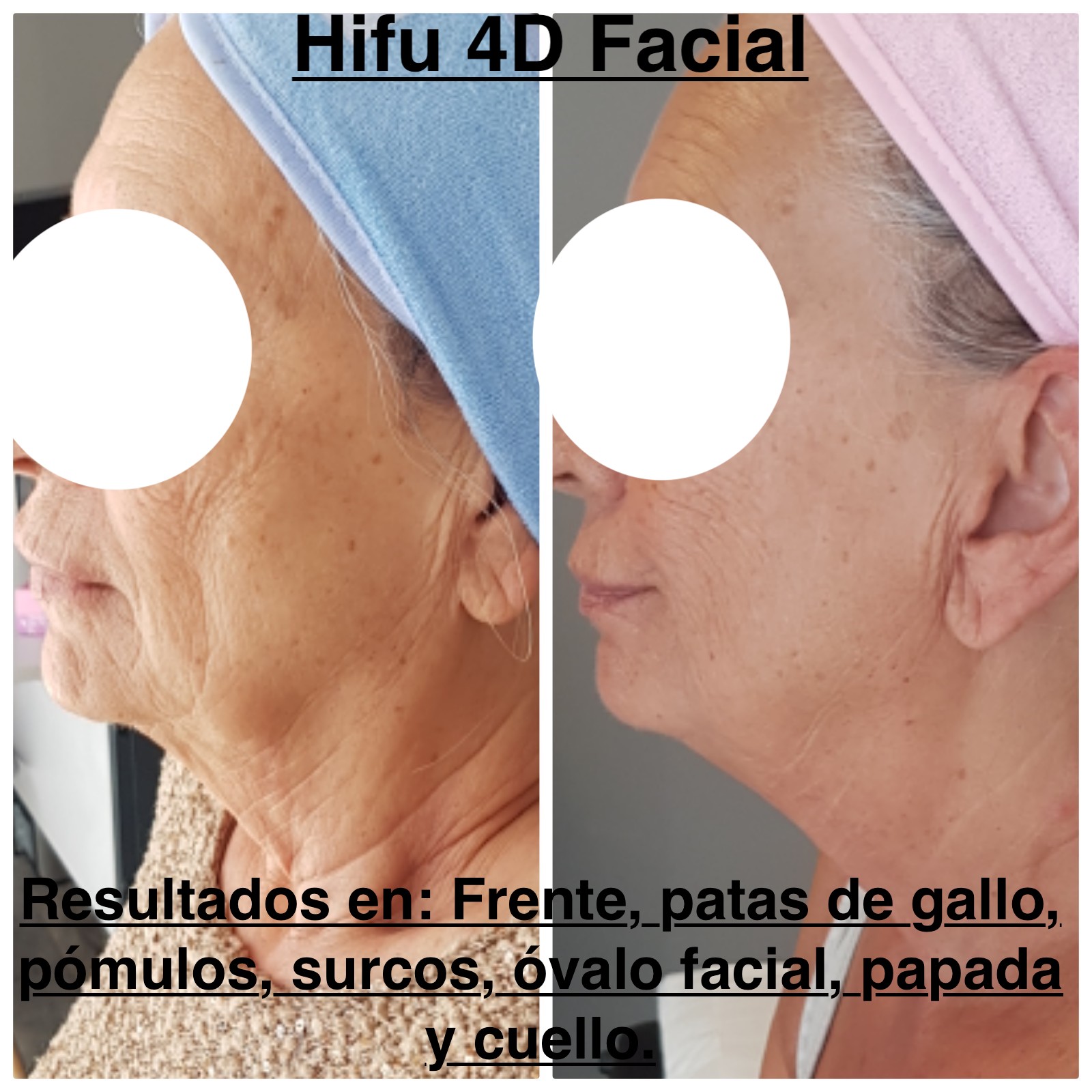 Hifu 7D – Dra. Carolina Mendoza